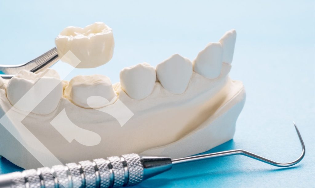 cracking the code frequently asked questions about dental crowns v2