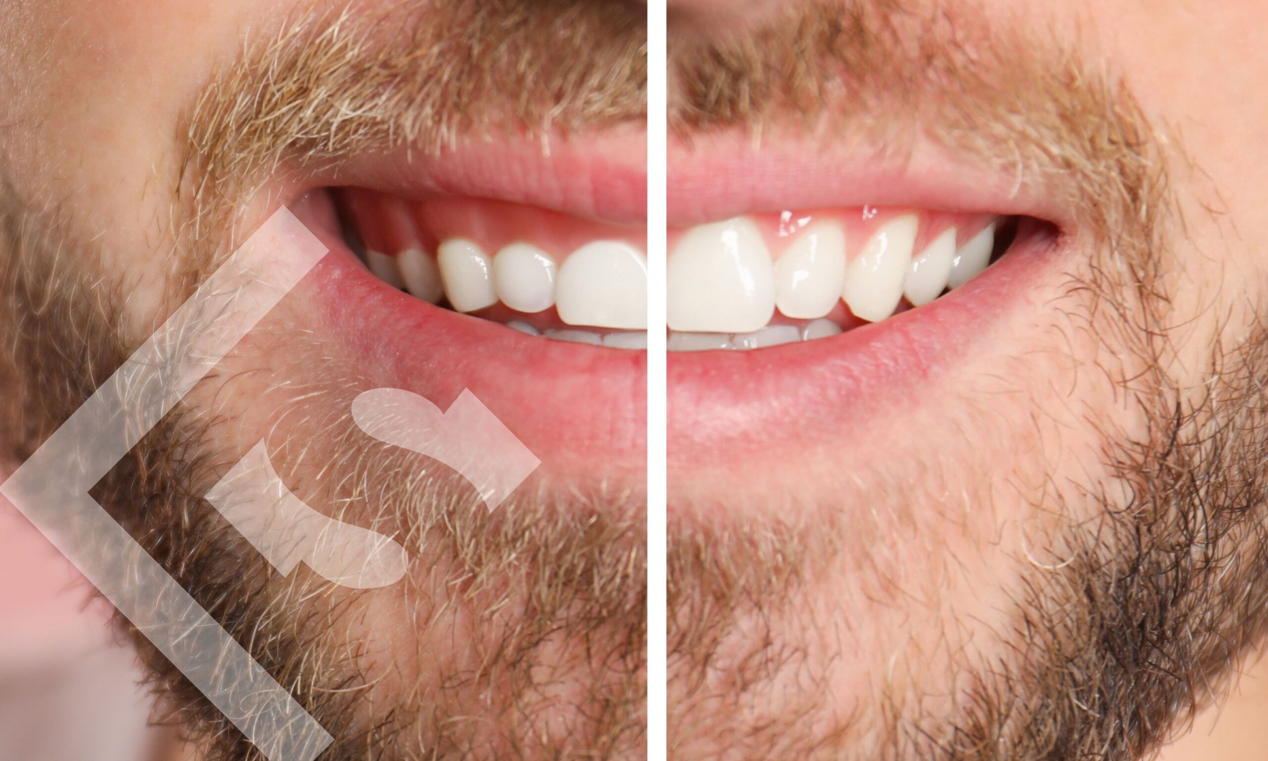 The Art of the Perfect Smile: Why Gum Contouring Matters!