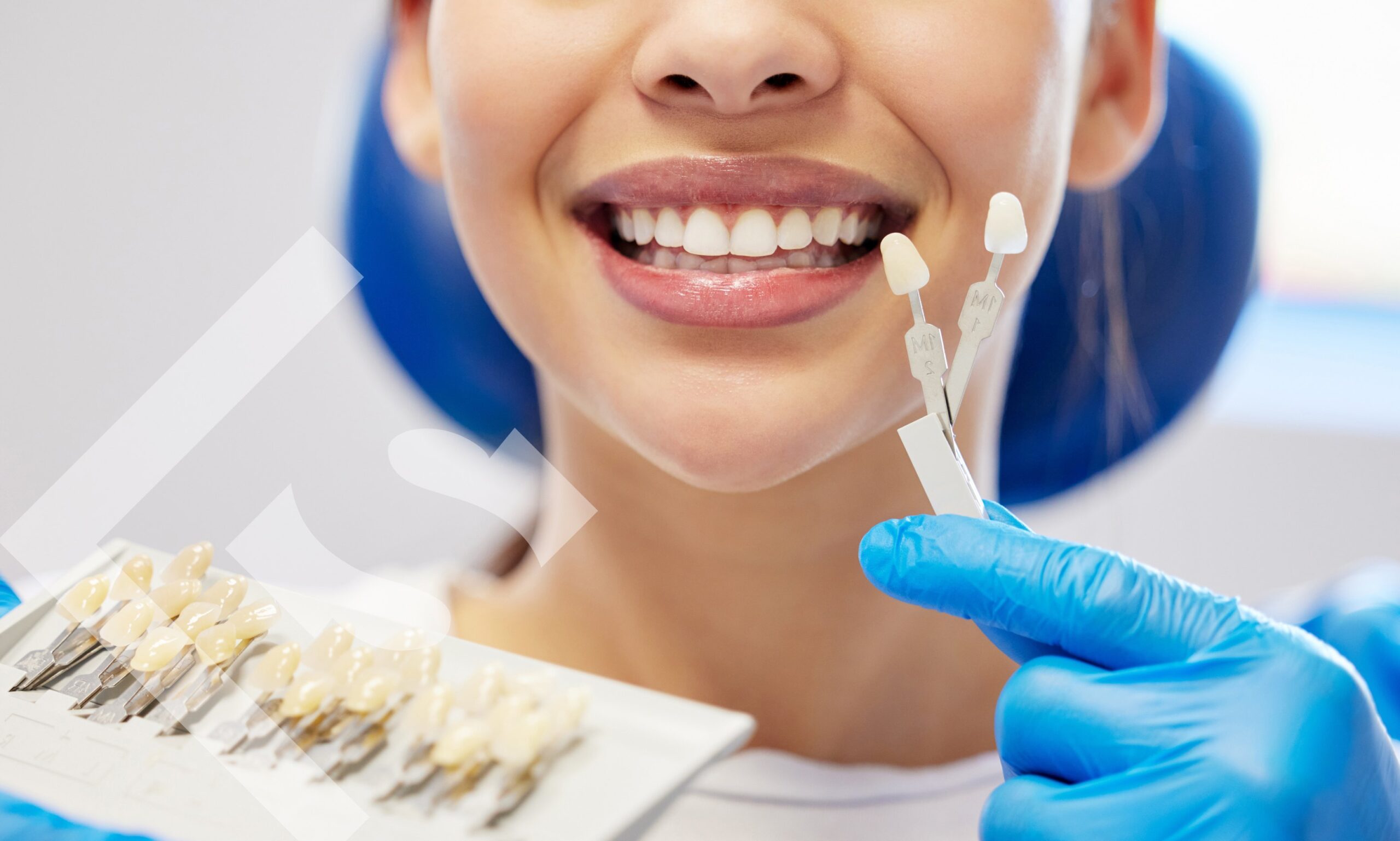 Are Veneers the Closet Staple of Your Smile? Like the White Tee That Always Fits!