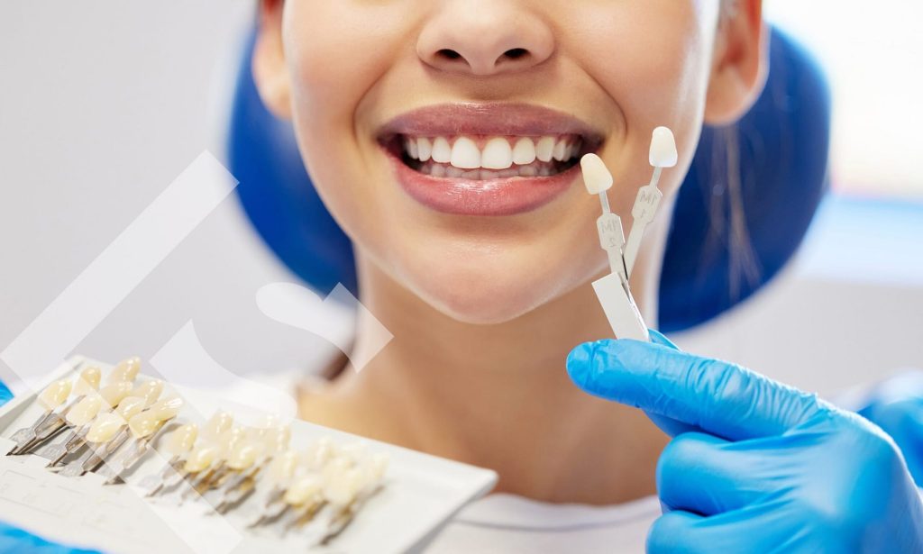 are veneers closet staple scaled