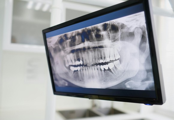 lum smiles exams & x rays