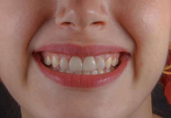 lum smiles gingival contouring