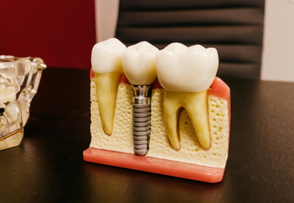 lum smiles implant restoration