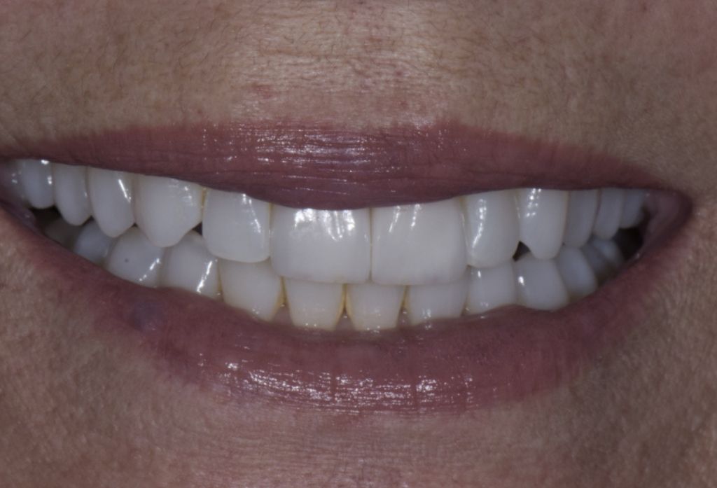 veneers17 after
